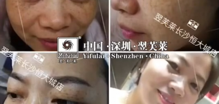 【治疗案例】翌芙莱长沙加盟连锁店雀斑患者的成功祛斑经历